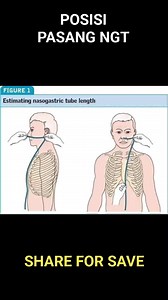 Pemasangan Nasogastric Tube atau NGT 🎗️ Siapa yang sudah melakukan? bagi pengalamannya dong 😬 | Perawat Peduli