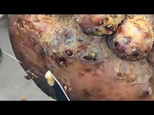 Albert Ombewa's jigger dig #1 - see long video @ riseupsociety.net & ruskenya.org