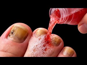 NAIL FUNGUS THIS TREATS BETTER THAN ANY CREAM! Only 3 ingredients from home