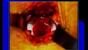 How I do an Anterolateral Approach