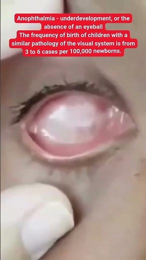 Anophthalmia - underdevelopment, or the absence of an eyeball