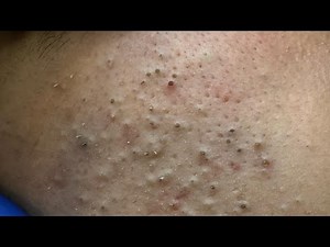 Deep Facial Cleansing | Satisfying Blackhead Removal Compilation