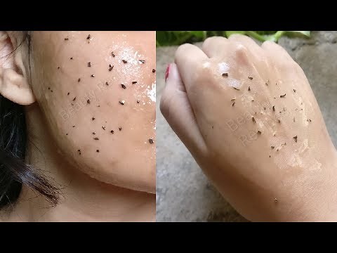 Removed Blackheads & Whiteheads from Nose, Chin & Face permanently in 1 week