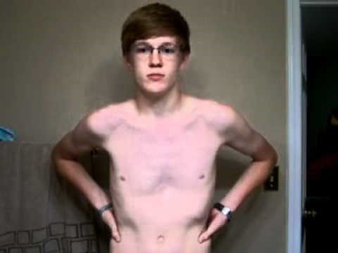 Pectus Excavatum Ravitch Procedure - Day 1