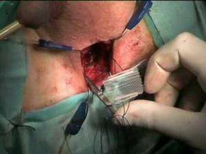 Male Re-Adjustable Incontinence Sling - MRS Remeex System