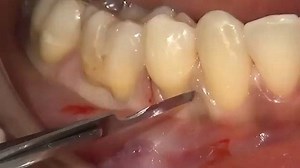 5.7K views · 60 reactions | gingival recession treatment  | Aesthetic Dentistry | Facebook