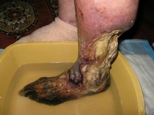 Drug Sorcery: New Krokodil Drug and Its Gruesome Effects!