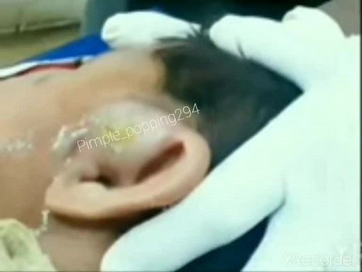 New video is out on my YT channel link is in my bio Massive Abscess On A Little Boy Ear #abscess #boilpopping #abscessdraining #fyp #foryou #pimple #cyst #popit #viral #satisfying #massive #2022 #new #youtuber #popit