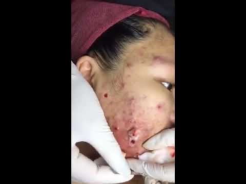 Wine #1: Girl and horrible acne face [Remove the worst acne on the face easily]