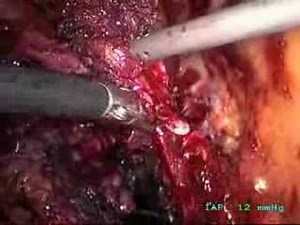 Laparoscopic Radical Prostatectomy