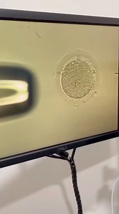 🌸 Understanding IVF: A Path to Parenthood 🌸** 🔬 What is IVF? In Vitro Fertilization (IVF) is a medical procedure where an egg is fertilized by sperm outside the body, in a lab. The fertilized egg (embryo) is then implanted in the uterus. 👶 Who Needs IVF? IVF helps individuals and couples facing infertility, including: - Blocked or damaged fallopian tubes - Male infertility factors - Ovulation disorders - Genetic disorders - Unexplained infertility 🩺 The IVF Process: 1. Stimulation : Hormone