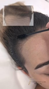 Thoughts on this Hairline Microfeather result? 殺 #hairlinetattoo #hairlinemicroblading #hairlinemicrofeathering #tanyabeautycare #annedo #hairlinerestoration #nonsurgicalhairreplacement #fyp #CapCut | Tanya Beauty Care | Facebook