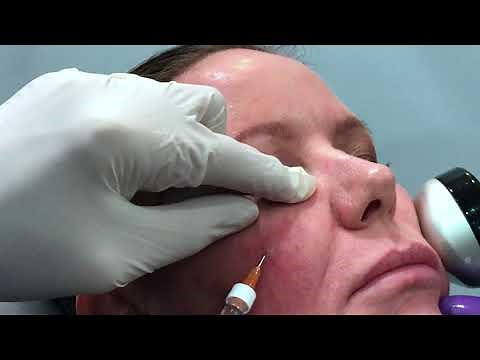 Dr. Weiner's Sandwich Technique Tear Trough Filler