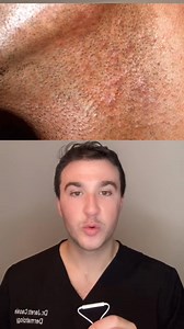 Pseudofolliculitis barbae! #derm #dermondemand #skin #hair #pseudofolliculitis#603 | Dr. Casale