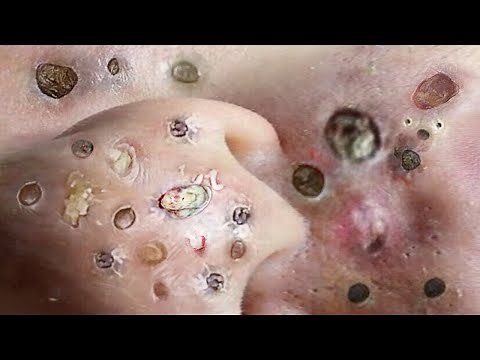 Loan Nguyen Acne Treatment 1547h