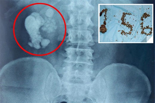 Man, 50, has 'record-breaking' 156 kidney stones removed during 3hr surgery