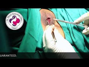 This is How Labiaplasty Surgery - Labia Minora Reduction is Operated Safely by Dr Mayuri Kothiwala