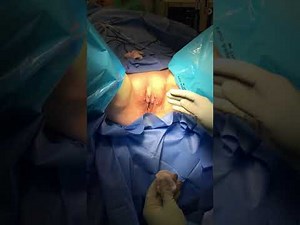 Labia Minora Reduction - Part 3