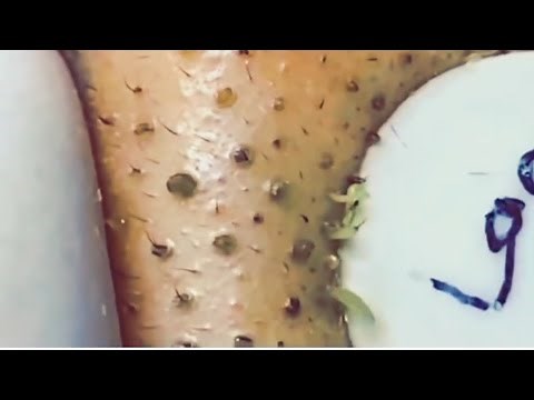 A Lots of Nose Blackheads | Small Nose Blackheads #blackheads #blackhead #acne #pimple
