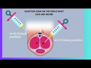 P shot procedure