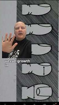 Finger Clubbing Explained - What causes finger clubbing?