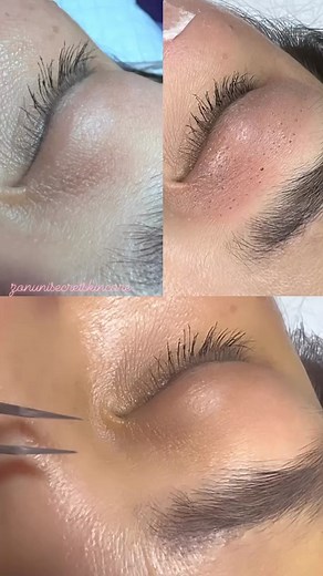 #plasmapen💕 | Zonuni Skincare