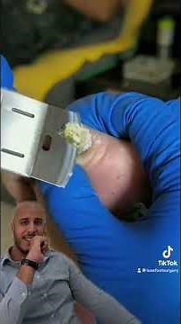 ODDLY SATISFAYING CALLUS SHAVING 🤯