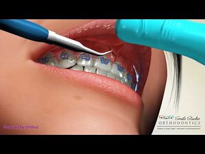 Frenectomy - Orthodontic Procedures