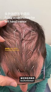 Scalp acupuncture for left hand tremor The patient just had a brain scan and is waiting for the results. Within two days after the last acupuncture treatment, the patient found that the frequency of the tremor in his left hand decreased, and the intensity of the tremor also decreased. If you are interested in learning more Please click the following link to let us know where do you want to join the New Balance Acupuncture workshop in 2025。 https://jo.my/2025xtzybm #AcuTcmSchool #szenanphua #NewB