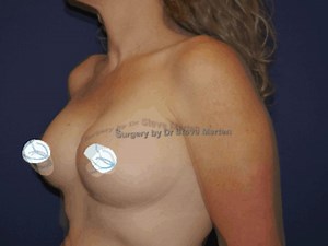Breast Augmentation 3D Morph
