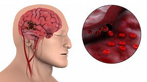 Scientists claim they know how AstraZeneca Covid vaccine causes rare blood clots