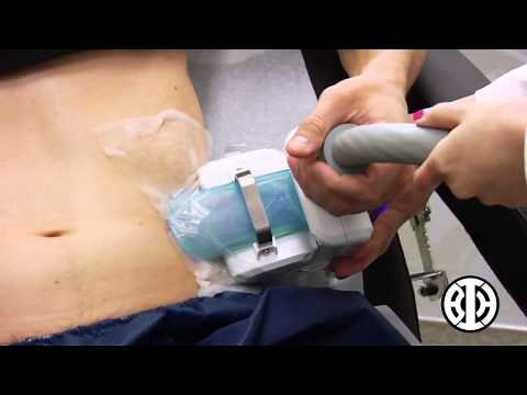 CoolSculpting to treat men's love handles
