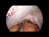 Suturing Skills in TAPP for Laparoscopic Groin Hernia Repair • Video • MEDtube.net