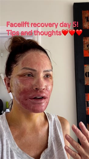 Lisa Boyle on Instagram: "Facelift recovery day 5 tips and thoughts @iveyplasticsurgery #facelift #faceliftrecovery #mauiphotographer #mauiboudoirphotographer #plasticsurgery #plasticsurgeryjourney #recovery #healing"