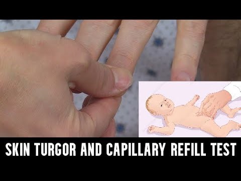 HOW TO CHECK SKIN PINCH AND CAPILLARY REFILL