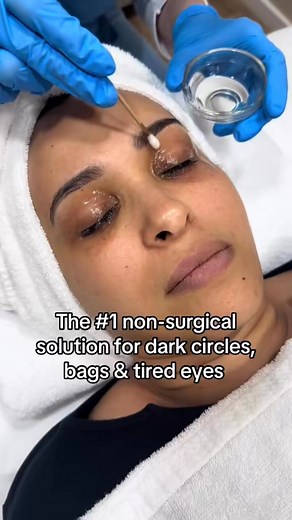 👁 Real, visible change — without surgery. The Global Eyecon is one of the most advanced, non-invasive eye contour treatments available in Europe.💬 Comment “eyes” to learn how you can achieve results like this. | Pasha Aesthetics - Med Aesthetic Clinic