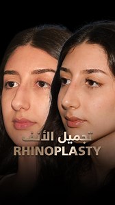 Refining Beauty: Experience the Art of Rhinoplasty by Dr. Bizrah. Unveil Your True Elegance, Guided by Expert Hands. 👃✨ اكتشف فن جراحة تجميل الأنف مع الدكتور بشار بزرة . أناقتك الحقيقية، بأيدي خبراء. 👃✨ Bizrahmed:800249724 Noura : 0555751770 Majd : 0568328505 Roula :0529998181 #خبرة_جراحة_الأنف #أناقة_حقيقية #_لدكتور_بشار #Bizrahmed #DrBizrah #Rhinoplasty #RefiningBeauty #ArtOfRhinoplasty #ExpertHands #RhinoplastyExpertise #TrueElegance #DrBizrahMagic | Dr Bashar Bizrah د بشار بزرة