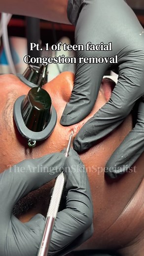 Teen Facial Extraction: Clearing Years of Pore Buildup