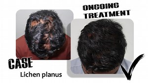 Here is a case of Lichen planus, which scars the scalp and makes it itchy due to inflammation! Let's watch the clip for more insight on how it's managed. #hairgrowth #haircare #hairrestoration #hairlosssolution #alopecia #lichenplanus #confidence | Hair Hub-The Trichology Centre