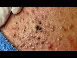Blackhead Removal With Sac Dep Spa @758