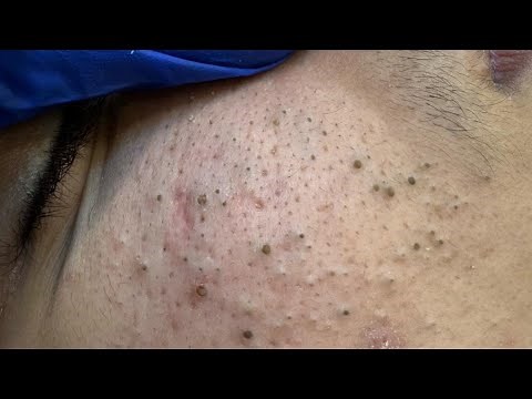 Deep Cleansing Techniques For Acne — At Home Blackhead Removal