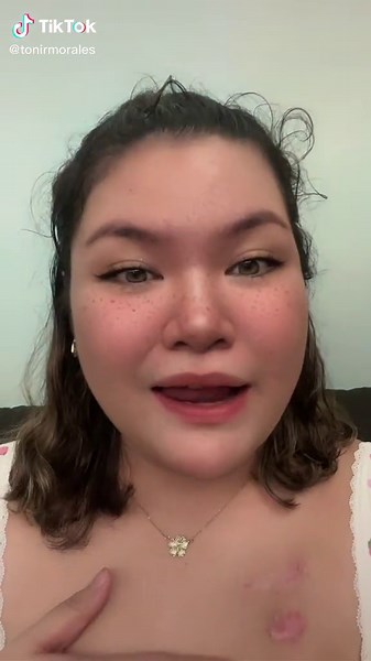 Nakakastress Story: My Surgery Experience | Cancer Fighter Chronicles