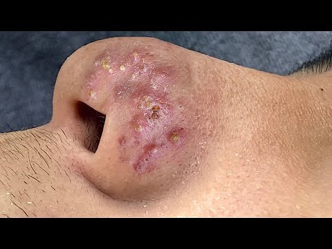 Suri Job #672: Awesome Acne Extraction