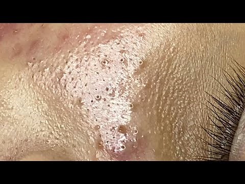 Loan Nguyen Acne Treatment (#105)