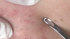 Don't use pore strips, these are much better