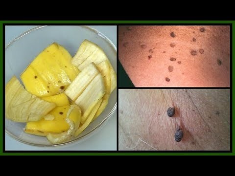 HOW TO GET RID OF SKIN TAGS | BANANA + APPLE CIDER VINEGAR GET RID OF SKIN TAGS FAST |Khichi Beauty