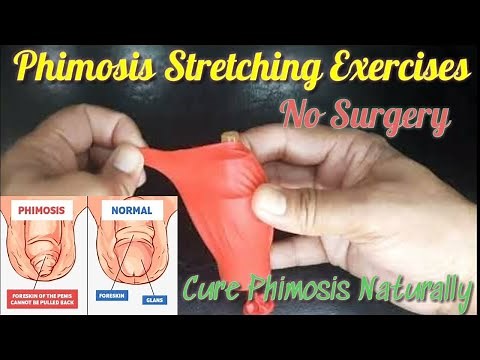 Most Effective Stretching For Phimosis | फाइमोसिस का बिना ऑपरेशन के इलाज | Phimosis | Tight Foreskin