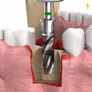 71K views · 638 reactions | ¡Ese nuevo procedimiento de implante dental es tan fascinante!  Crédito: SIC invent AG, sic-invent.com | Vallenatazos | Facebook
