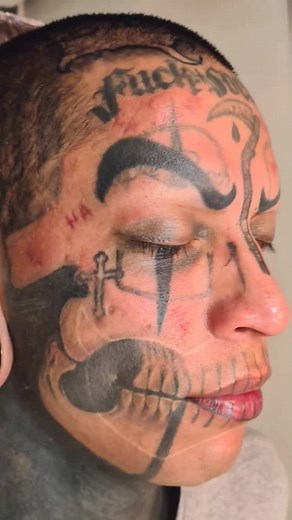 Efeito de 4 Sessões de Laser para Rosto Limpo