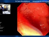 Pancreas Divisum Endoscopic View of Minor Papilla • Video • MEDtube.net